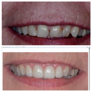 A before and after picture of the teeth whitening process.