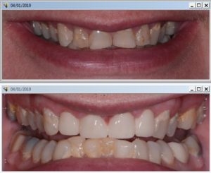 A before and after picture of teeth with missing tooth.