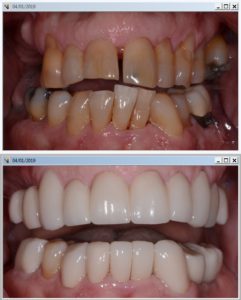 dirty back teeth before and after