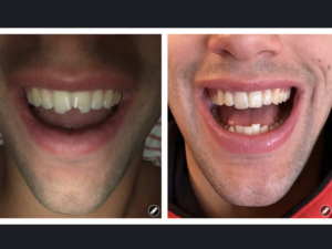 chipped teeth before and after