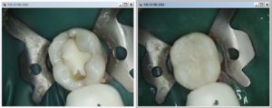 A picture of the tooth with and without restorations.