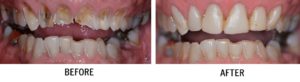 A before and after picture of the teeth with plaque.