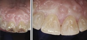 A before and after picture of the teeth with porcelain fillings.