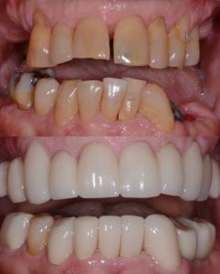 A close up of teeth with and without porcelain crowns