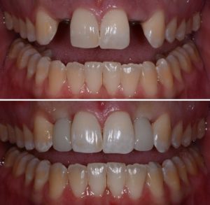 A before and after photo of teeth with porcelain veneers.
