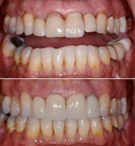 A before and after photo of teeth whitening
