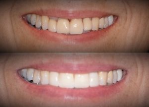 uneven teeth before and after