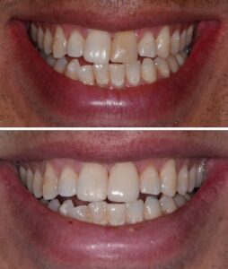 jagged teeth before and after