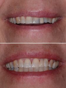 A before and after photo of a woman 's teeth.